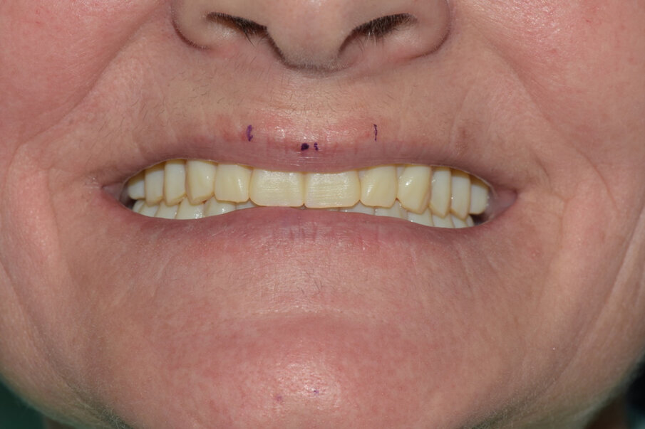 Fig. 13: Try-in of modified wax try-ins.