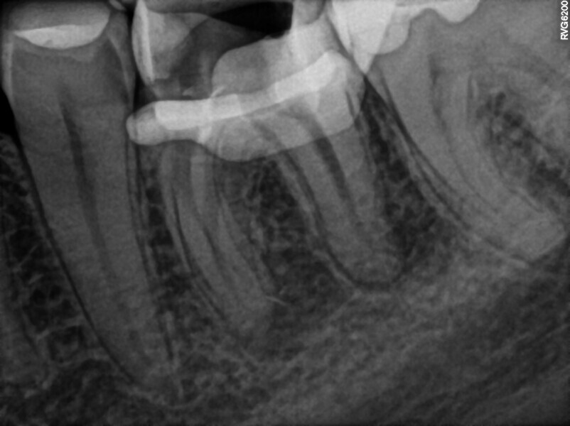 Fig. 35: Intra-op radiograph. All pieces of the broken files had been removed.