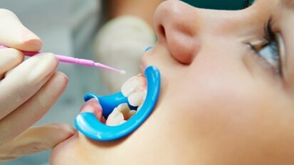 Confirman la eficacia de los selladores dentales en la caries infantil