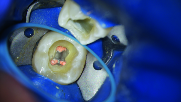 From a distal