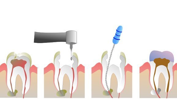 New dental procedure could replace root canal treatment