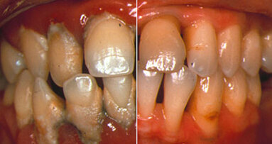 Where periodontology has advanced
