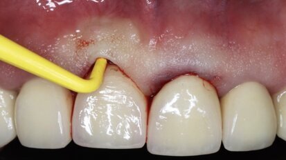 Importante Curso sobre Medicina Periimplantar