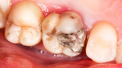 Amálgama não tem lugar na indústria odontológica