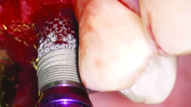 Zimmer lance un implant avec une fonctionnalité d'ostéo-incorporation