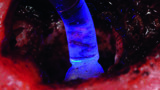EndoGuide Lens_apikale retrograde Fuellungen