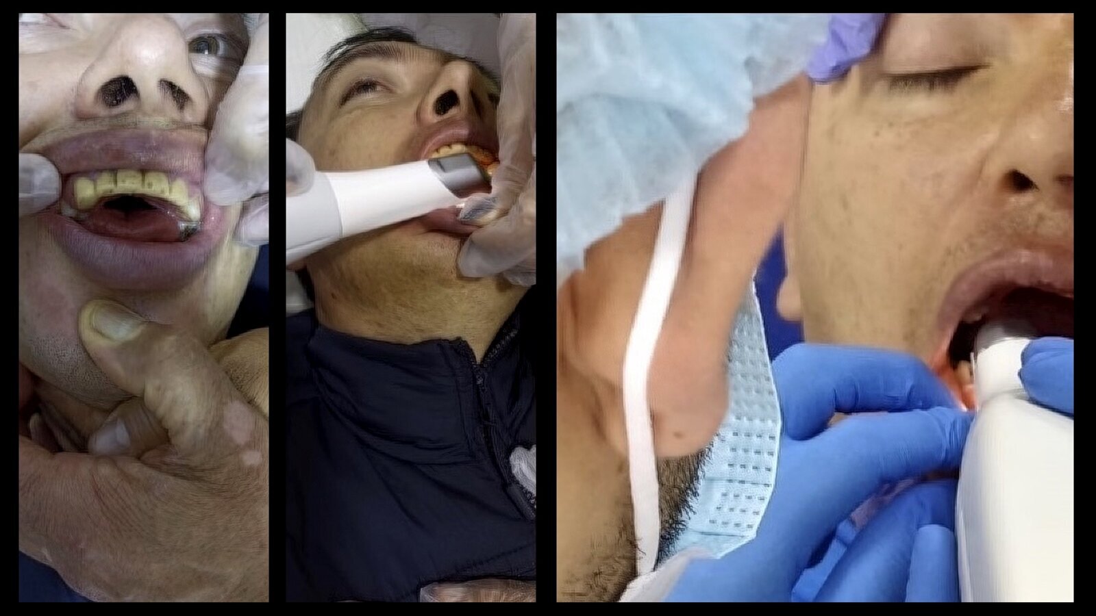 Rehabilitación oral de un paciente con síndrome de Lennox-Gastaut e hipoxia perinatal