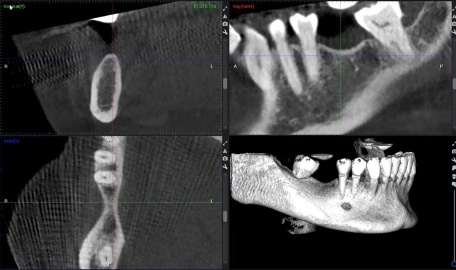 Fig. 16_Immagini CBCT preoperatorie del sito 46.