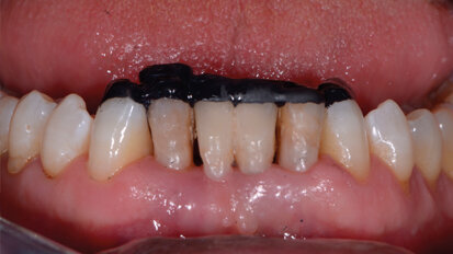 Composito nero: un nuovo ausilio nello Smile Design
