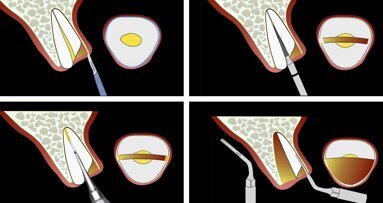 Piezocirugía  (8). La llegada de la exodoncia atraumática