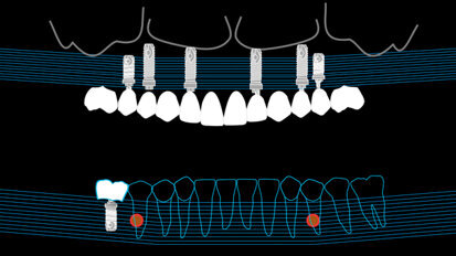 Riabilitazione implanto-protesica di un caso complesso alla luce delle nuove tecnologie: un caso clinico