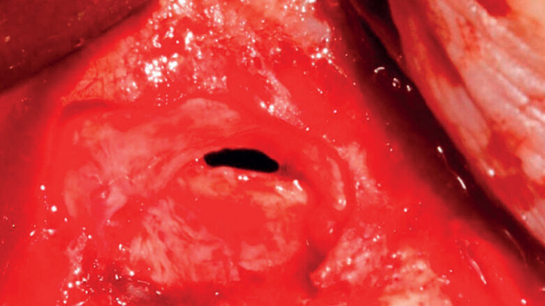 Complicaciones intraoperatorias