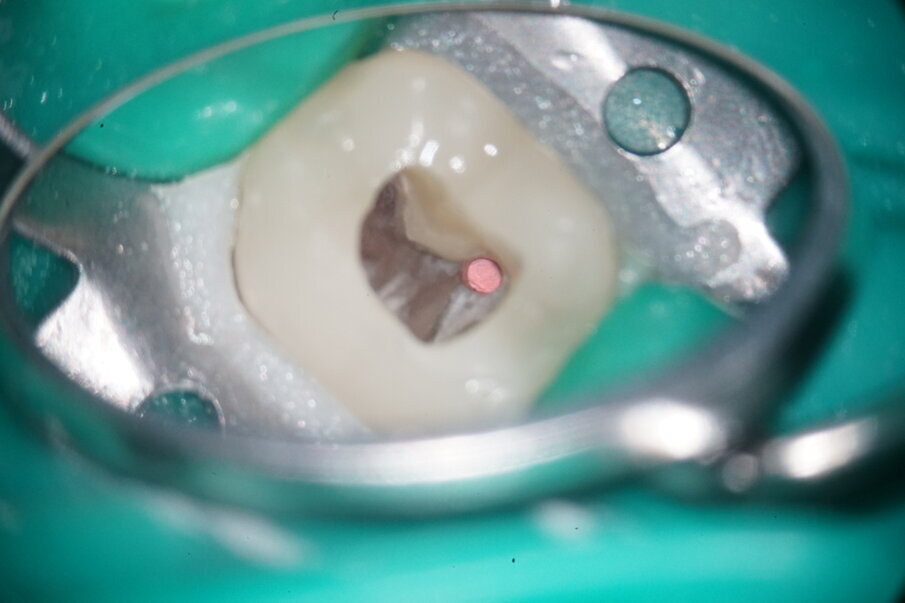 Fig. 13: Fillings in situ mesially.
