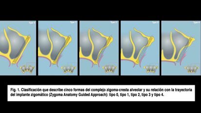 Implantes zigomáticos en el edéntulo maxilar con reabsorción severa
