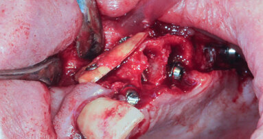 Radicular transplantation—The use of dental roots in the treatment of bone insufficiency