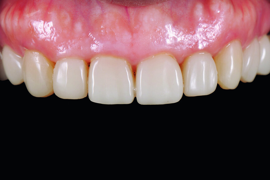 Fig. 25: Four-year follow-up: frontal view of upper anterior dentition.