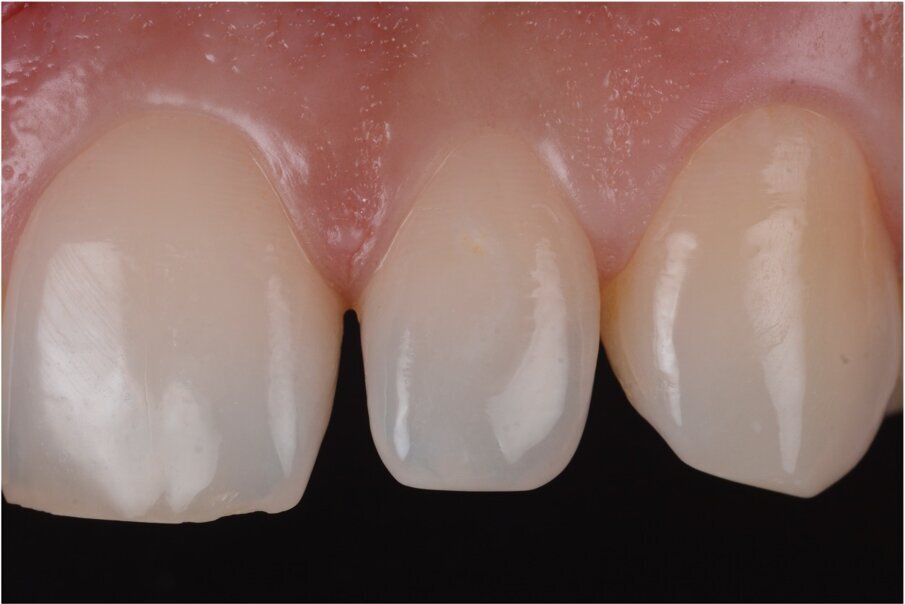 Case 1, Fig. 1.