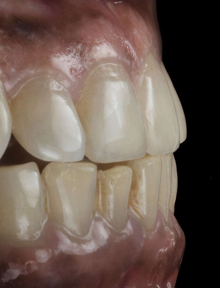 Fig. 17: Artistic side view of both dental arches in anterior guidance 1 week post-treatment showcasing complete rehydration of tooth and natural life-like aesthetics