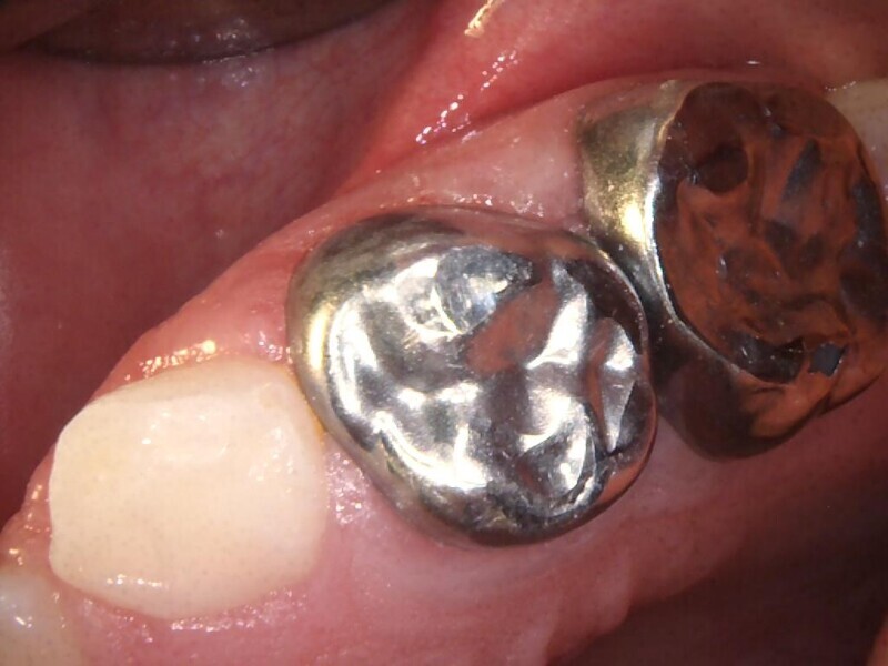 Fig. 23 : Aspect clinique lors de l’évaluation finale montrant un tissu gingival sain.