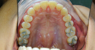 Study reveals environmental impact of dental amalgam
