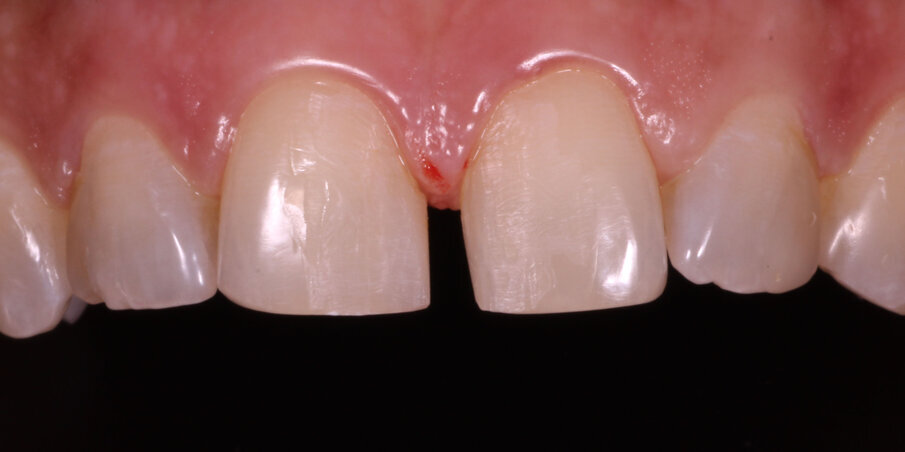 Fig 2. Pre-op