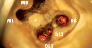 Dentální operační mikroskop v endodoncii