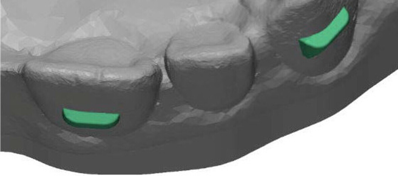 Figs. 12a & b: 3D printing easily produces a tooth-facing side that matches the patient’s anatomy.