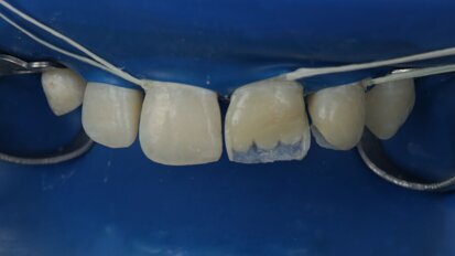 Polychromatic Layering Technique (PLT)—full protocol: a case report