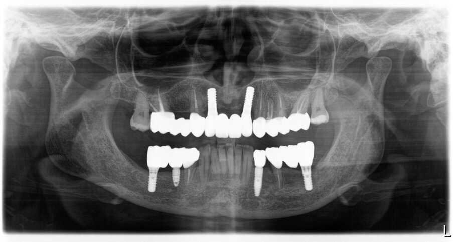 Fig. 51_Radiografia a 5 anni dalla consegna del lavoro. Ai follow-up vengono eseguite annualmente delle rx endorali centrate, e alla necessita viene ripetuta un’opt.