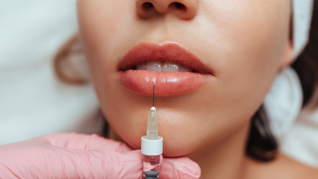 Hyaluronzuurfillers: kunnen vollere lippen te vol zijn?