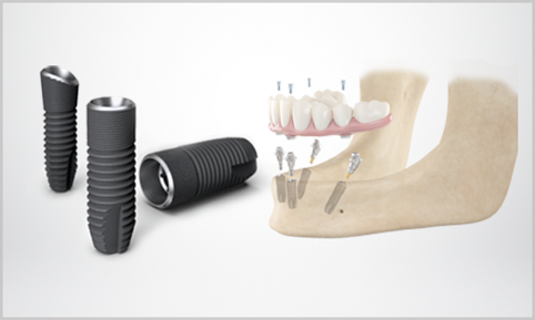 SmartFix concept - fixed restorations