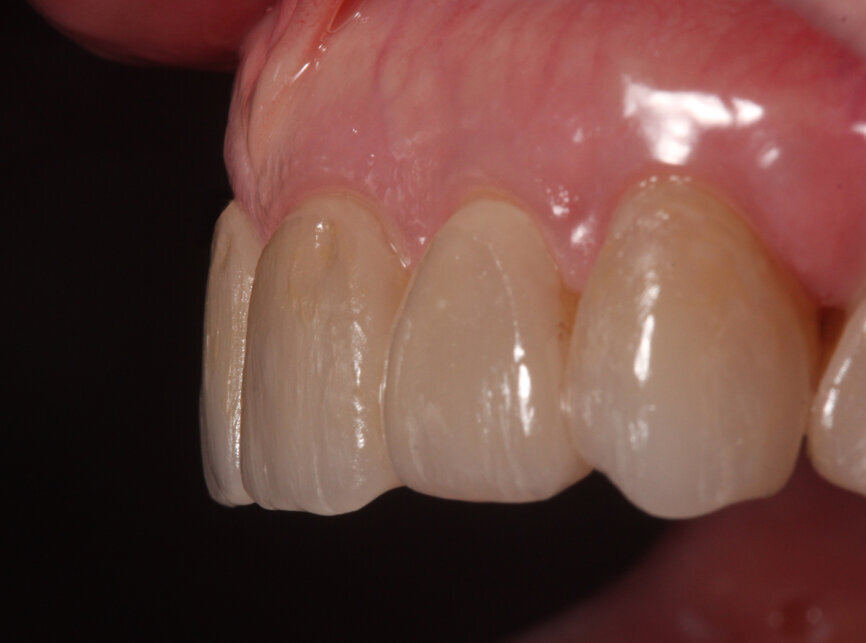 Fig. 22: Bonded veneers, lateral view.