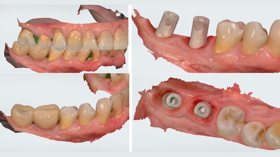 Fig. 16_Immagini della scansione 3D eseguita con scanner ottico per eseguire il manufatto protesico definitivo.