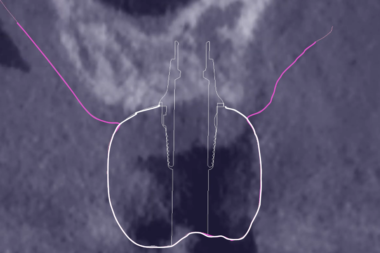 Fig. 5c: Merging of the STL file of the prosthetic abutment (thin white line) with the previous superimposition.