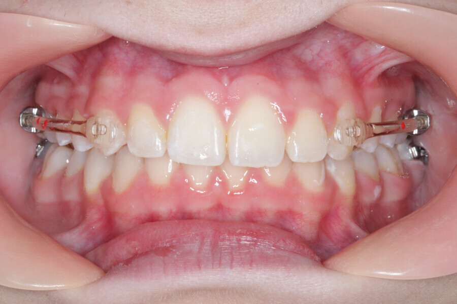 Fig. 8: Placement of the Carriere Motion 3D Clear Class II appliance.