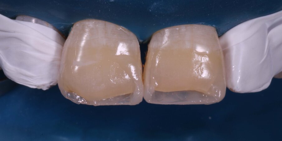 Fig 10: Building proximal walls in enamel shade composite after creating the palatal enamel shell