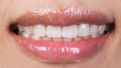 Meeting an anterior esthetic challenge