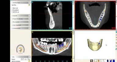 Materialise Dental et Zimmer Dental établissent un partenariat