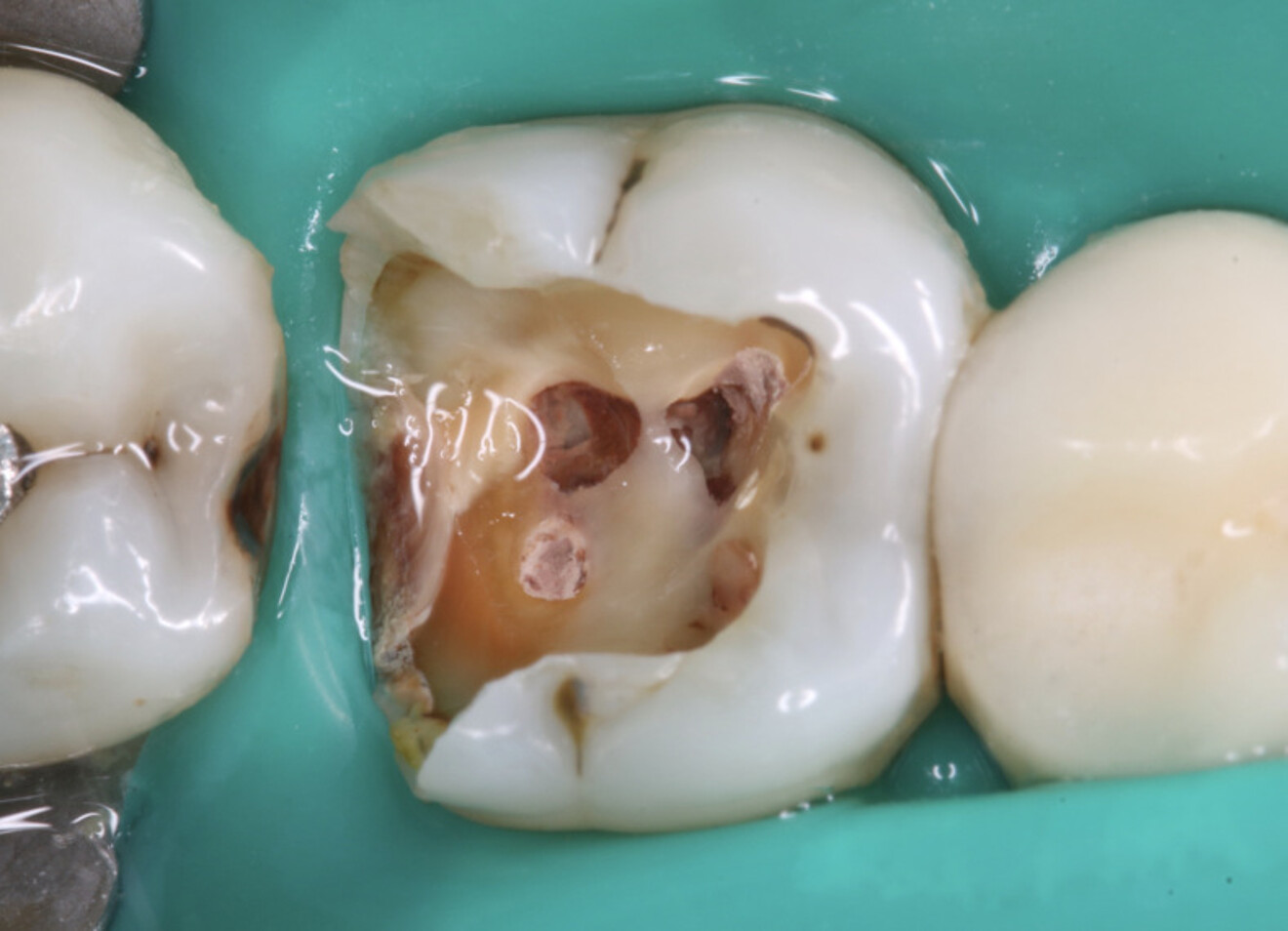 Fig. 18 : Le retrait de la restauration coronaire fait apparaître des résidus sur le plafond de la cavité pulpaire ainsi que des matériaux de scellement du canal radiculaire.