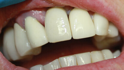 Case report: ‘unidentified dental implant’ restoration