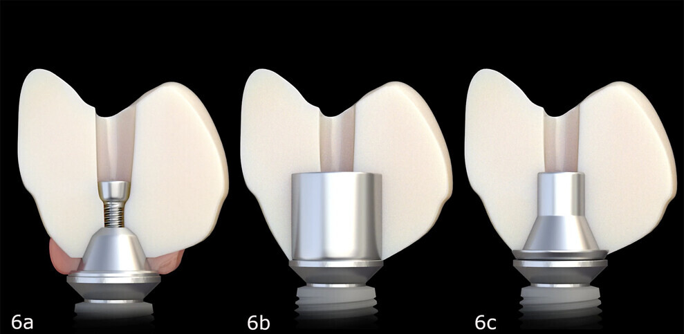 Figs. 6a–c: Three methods of attaching zirconia restorations to implants. Conventional multi-unit abutment (a). Titanium bar (b). Titanium base (c).