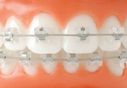 Dentsply – GAC BioForce High Aesthetic Archwire