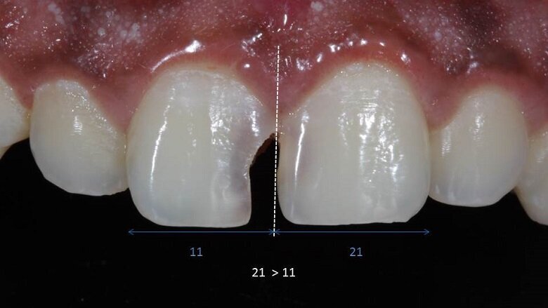 Fig 2: mesial tipping of 21
Discrepancy in mesio-distal width
11