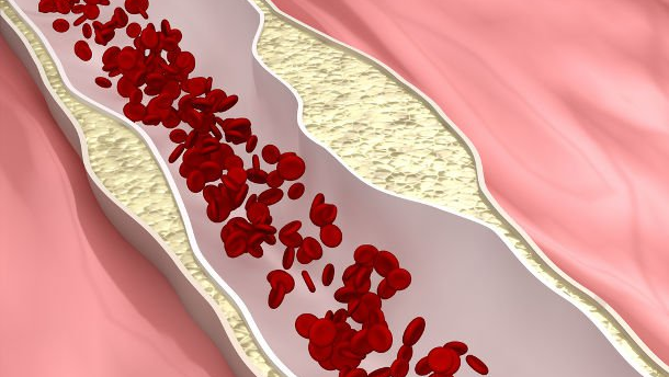 La terapia periodontal mejora el corazón en poblaciones de alto riesgo