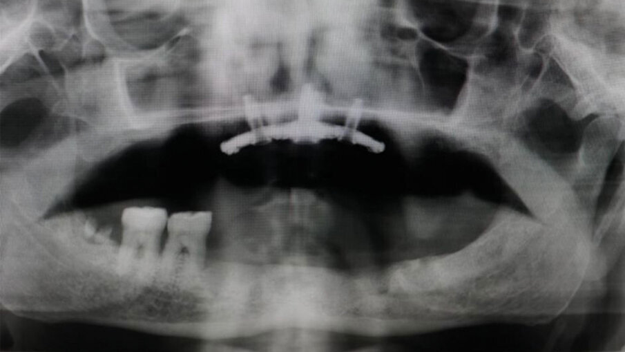 Fig. 7 - RX dopo l’inserimento del Premaxillary Device.
