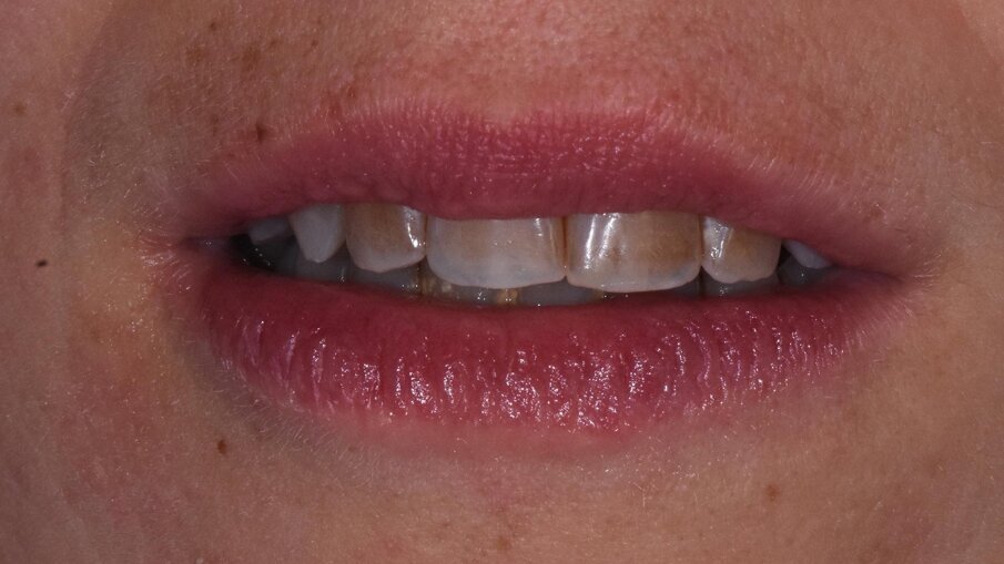 Fig. 8 - Lievi pigmentazioni degli elementi 1.2 e 2.2 a due mesi dal primo trattamento remineralizzante con CPP-ACP mousse e dentifricio base di silicato di calcio e fosfato di sodio con tecnologia brevettata NR-5.