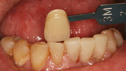 Three-unit, full-contour ceramic bridge in one sitting