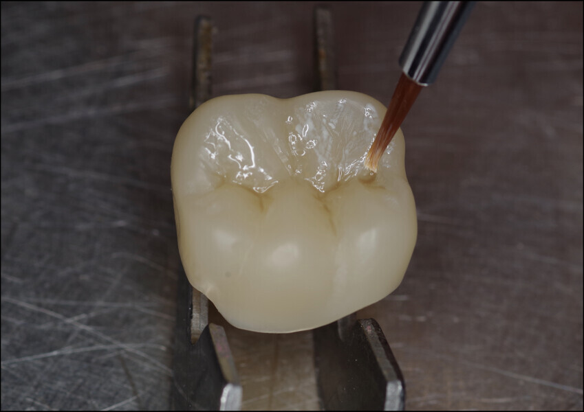 Fig. 15: Application of white stains to characterise the colours of the restoration.