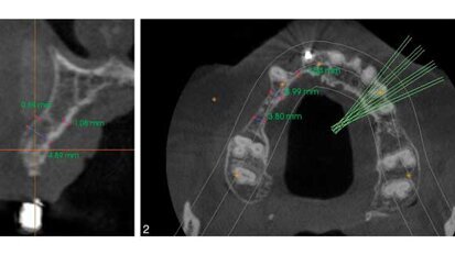 A comparison of graft techniques for the alveolar ridge prior to oral implant