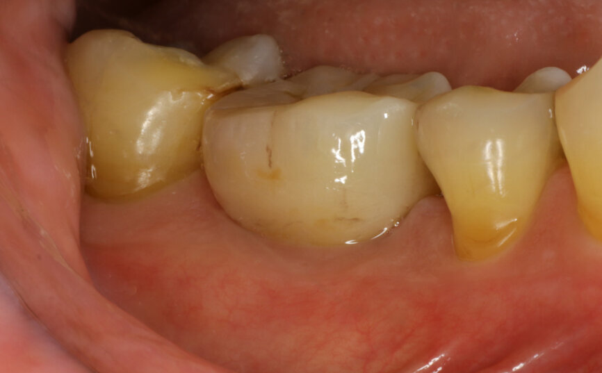 Fig. 27: Straumann TLX one-year follow-up clinical outcome.